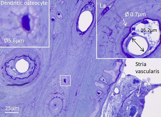 Histological sections of the human otic capsule in a non-otosclerotic ear (glutaraldehyde fixation). The blood vessels reach the endosteal layer within a 100-μm range from the spiral ligament and stria vascularis. The framed area shows a dendritic osteocyte that is magnified in the left inset. Purple canaliculi radiate from the lacuna. Canaliculi have a diameter of around 0.7 microns and connect to the vascular bone channels (arrow). La, lacuna.
