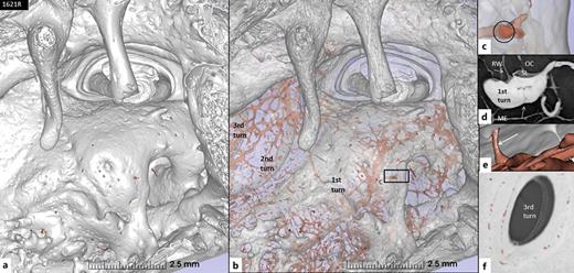 SR-PCI and 3D rendering of a left non-otosclerotic cochlea showing middle ear projections of the three cochlear turns (1621R). a Lateral surface view of the medial wall of the middle ear shows several openings of vascular bony channels into the middle ear mucosa. b Bony wall was made semitransparent to demonstrate the vascular channel system in the otic capsule (stained red). The vascular network is particularly prominent at the promontory region of the first turn of the cochlea. The framed area shows a vascular channel opening and is magnified in (c) (encircled). d Section at the same level shows a vascular channel communicating with vessels in the middle ear mucosa (arrow). e Cross section of communicating channels in the promontory. f Section of the third turn with segmented bone channels. ME, middle ear; RW, round window; SL, spiral ligament; OC, organ of Corti.
