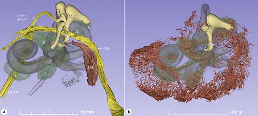 SR-PCI and 3D rendering of a left otosclerotic cochlea (1564L) demonstrating five different lesions (1-5). a The otosclerotic lesions (green) were manually segmented. Lesion 1 was located in the wall of the internal acoustic meatus. The most affected area was around the oval window. b The vascular channel system in the otic capsule lesions was manually segmented and connected to the surrounding air cells, which were segmented through automatic threshold detection. FN, facial nerve; IN, intermediate nerve; SM, stapedius muscle.