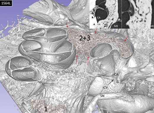 Superior view of the 3D-rendered inner ear demonstrating lesions 2 and 3 (red arrows) together with the cochlear envelope. At this level, these two lesions (2 and 3) do not reach the cochlear aqueduct (CA) and ICV. Left inset shows otosclerotic changes reaching more inferiorly the CA (arrow). Right inset displays connecting channels between the promontory and spiral ligament in the lower basal turn (arrow). SL, spiral ligament; ME, middle ear.