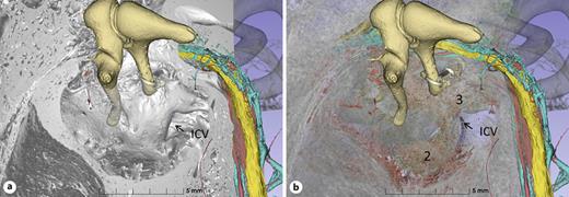 3D reconstruction and middle ear view of the promontory wall in the otosclerotic ear before (a) and after (b) transparency algorithm application. The localization of the round window lesion (2) and inferior cochlear vein (ICV) are shown. Lesions 2 and 3 are connected through vascular bone channels.