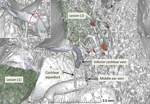 3D algorithm of the otosclerotic ear (inferior view). Lesions 1 and 2 are segmented together with connecting vascular bone channels. Lesion 2 partly involves the inferior cochlear vein (ICV) which drains all blood from the cochlea. It is dilated with a short narrowing and collateral at the otic capsule (encircled in the inset).