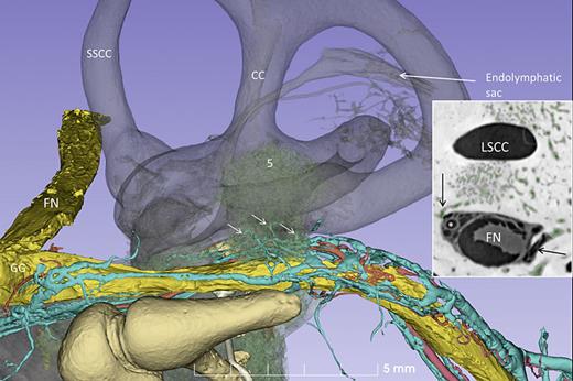 3D image of the horizontal portion of the facial nerve and associated blood vessels. Several veins connect to pathologic lesions 4 and 5 (small arrows). Inset shows the section with segmented otosclerotic blood vessels (arrows) anastomosing with facial nerve vessels (*). FN, facial nerve; SSCC, superior semicircular canal; LSCC, lateral semicircular canal; CC, common crus; GG, geniculate ganglion.