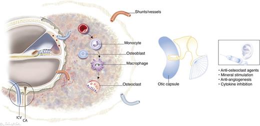Hypothetical intervention to alleviate histological otospongiosis and angiogenesis via middle ear drug delivery based on the present findings. Invading lesions commonly involve the basal cochlea with developed vascular shunts, causing disturbed microcirculation and increased venous flow [12]. Lesions may obstruct venous outflow through the inferior cochlear vein (ICV), leading to vascular congestion, stria dysfunction, and degeneration of sensory structures. Sclerotic phase is characterized by deposition of new bone by osteoblasts [54]. Local treatment could aim to reestablish bone metabolism, reduce angiogenesis, and restore venous outflow and CA patency. CA, cochlear aqueduct.