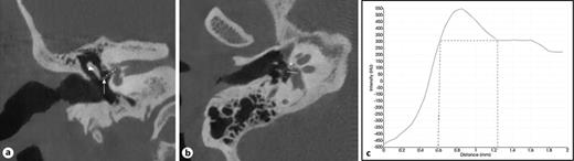 Reconstruction and line profile analysis of tapes footplate thickness in oblique axial stapes plane in right temporal bone. a Coronal plane with long incus process (white arrowhead) and incudostapedial joint (white arrow) are indicated. Dashed line depicting the used reconstruction plane perpendicular to the stapes footplate. b Corresponding reconstructed oblique axial stapedial plane. Asterisk showing antefenestral otospongiotic focus. Line profile analysis is performed in the anterior third of stapes footplate along the white line. c Illustration of a two dimensional coordinate system with plotted data of the footplate thickness in distance (mm) and intensity (Hounsfield unit) on x-axis and y-axis, respectively, measured by peak-valley detection in MATLAB.