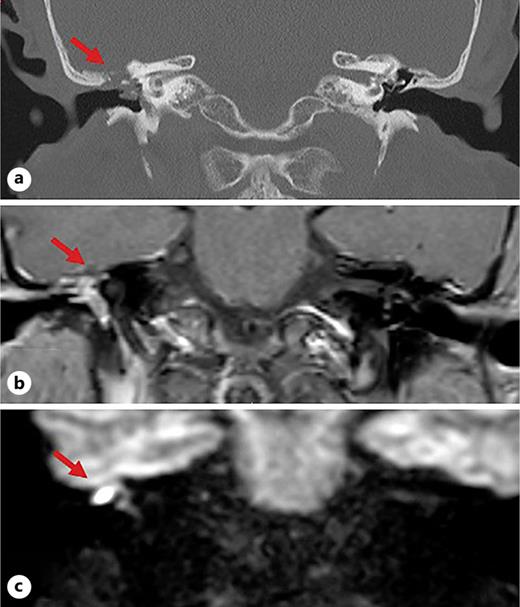 Case 1. a CT scan demonstrating right tegmen tympani defect, ossicular chain erosion, and middle ear fullness (arrow). b T1-weighted (+ contrast) MRI demonstrating possible TB-MEC into the middle ear (arrow). c Diffusion-weighted imaging demonstrating restricted lesion adhered to the tegmen tympani, suggesting cholesteatoma (arrow).