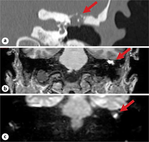 Case 3. a CT scan demonstrating left tegmen possible erosion (arrow). b T1-weighted MRI demonstrating a hyperintense lesion adhered to the tegmen (arrow). c Diffusion-weighted imaging demonstrating restricted lesion inferior to the TB-MEC, suggesting possible cholesteatoma (arrow).