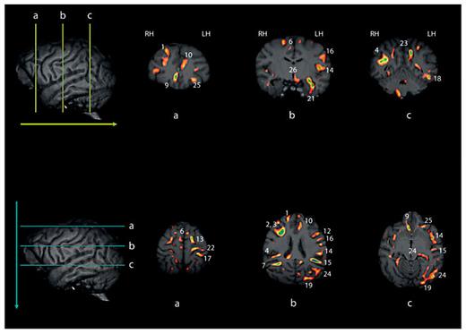 Fig. 2. Upper and lower panels reflect selective coronal (upper) and axial (lower) views of the different white matter cluster revealed by VBM. The numbers in each corresponding image reflect the cluster identified in table 1. Note, some clusters are unlabeled and in these cases, the clusters are visible on the single slice shown in the image, but the size of the cluster when considered across multiple slices may not have reached our size criterion (see text for description). LH = Left hemisphere; RH = right hemisphere.