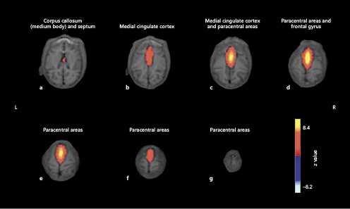 Executive control in the spider monkey. The figure shows seven axial slices, with the spatial color-coded z map components overlaid on the echo-planar image obtained from the mean for the three subjects. A higher z score (yellow) represents a higher correlation between the time course of that voxel and the mean time course of this component. Mean components comprise the corpus callosum (a), the medial cingulate cortex (b), the medial cingulate cortex and paracentral areas (c), the paracentral areas and frontal gyrus (d), and the paracentral areas (e–g).