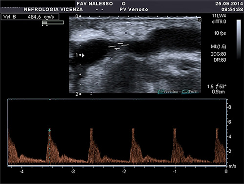 Standardized Protocol for Hemodialysis Vascular Access Assessment: The ...