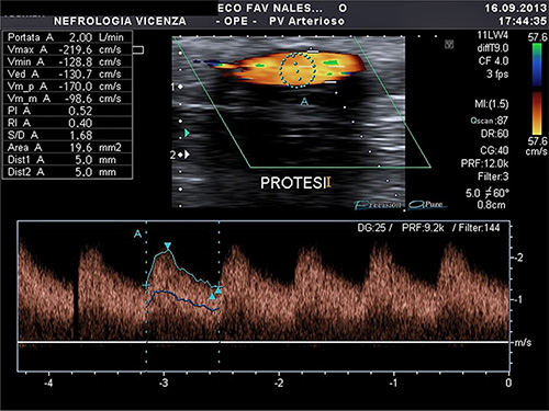 Standardized Protocol for Hemodialysis Vascular Access Assessment: The ...