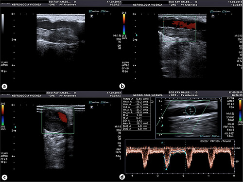 Standardized Protocol for Hemodialysis Vascular Access Assessment: The ...
