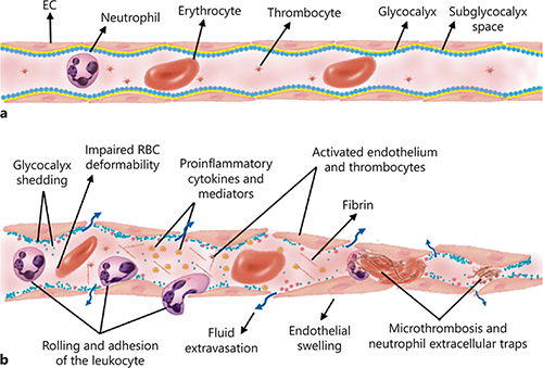 Fig. 2. Microvascular dysfunction and vascular endothelial damage. a The structure of a healthy microvessel is shown. EC and glycocalyx cover the lumen of the microvessel. The blood cells (leukocytes, RBC, thrombocytes) flow together with plasma inside the microvessels. b Microcirculatory damage can be caused by ischemia, reperfusion, inflammation, and hypoxia, resulting in endothelial and glycocalyx and RBC damage. Activation of leukocytes induces rolling, adhesion, and ultimately extravasation to the tissue, which further accelerates the inflammation. Decreased vascular permeability causes vascular leakage and edema formation. RBC, red blood cell; EC, endothelial cells.