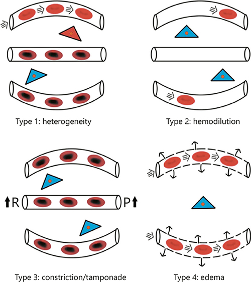 Fig. 3. Condition of microcirculatory alterations associated with loss of hemodynamic coherence and reduced oxygen capacity of the tissues. Type 1: Heterogenous RBC flow caused by RBC and endothelial cell injury induced for example by sepsis results in RBC stagnant capillaries next to perfused capillaries resulting in microcirculatory shunts and a reduction of tissue oxygen extraction capacity. Type 2: A decrease in the oxygen-carrying potential of the microcirculation due to hemodilution induced anemia resulting from a low FCD. Type 3: A stasis in the RBC flow due to increased vascular resistance (R) [37] and/or elevated venous pressure (P) [38]. Type 4: Increased oxygen diffusion distances due to edema caused by capillary leak syndrome. Adapted from Ince [67].