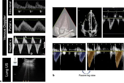 Examples of ultrasound features that may complement other clinical information to inform decisions related to fluid management on RRT. a Features suggestive of organ congestion including venous Doppler anomalies at multiple sites and B-line artifacts (orange arrows) on lung ultrasound (US). b Left ventricular outflow tract pulsed wave Doppler to assess the VTI which is proportional to left ventricular stroke volume. Significant change in the VTI following a preload-modifying maneuver may identify a preload-dependent state in which tolerance to fluid removal may be limited.