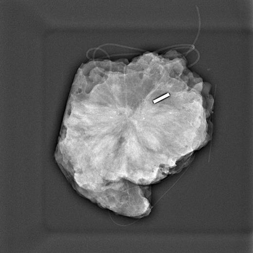 Seed (Magseed) Localisation in Breast Cancer Surgery A