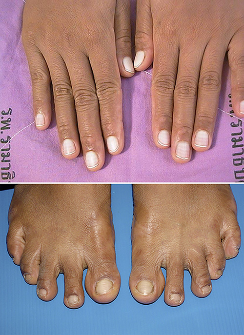 Hereditary Leukonychia Totalis A Case Report and Review of the