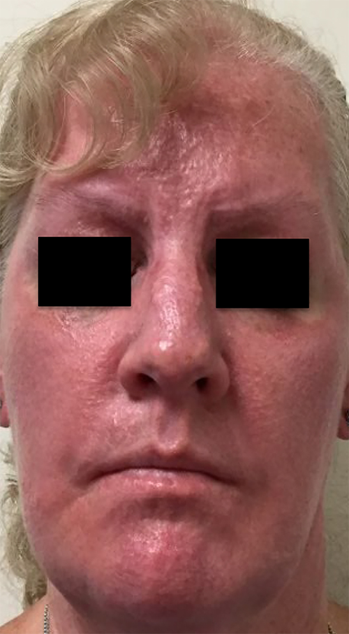 Fig. 1. Scleromyxedema with erythematous, confluent papules and waxy, thickened skin of the face.