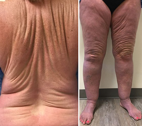 Fig. 2. Scleromyxedema with indurated, erythematous skin folds demonstrating the “Shar Pei sign” on the back (left) and bilateral legs (right).