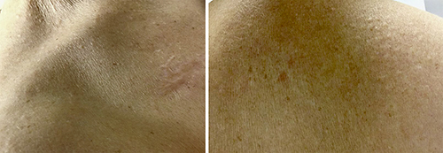 Fig. 3. Discrete papular lichen myxedematosus presenting with firm, smooth, 2-mm whitish to skin-colored papules on the neck (left) and upper back (right).
