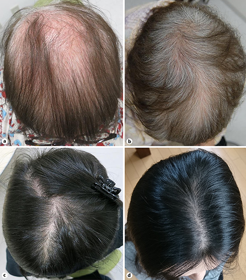 Alopecia Diffusa while Using Interleukin17 Inhibitors against