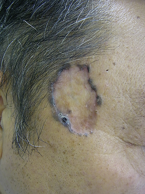 Spontaneous Regression of Annular Basal Cell Carcinoma A Case Report