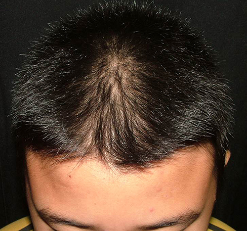 Fig. 1. A patch of hair thinning on the frontal area of the scalp without scale or erythema.