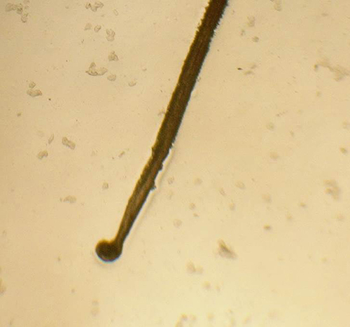 Fig. 2. Microscopic examination shows a naked anagen hair bulb with ruffling of the hair cuticle (original magnification ×20).