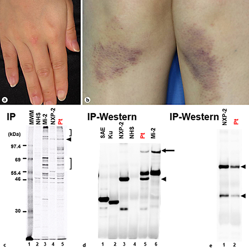 A Case of Dermatomyositis Coexisting with Both AntiMi2 and AntiNXP2