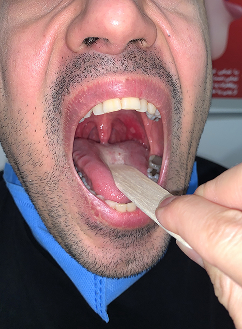 Fig. 1. Erythema and aphthous lesion on the left tonsil.