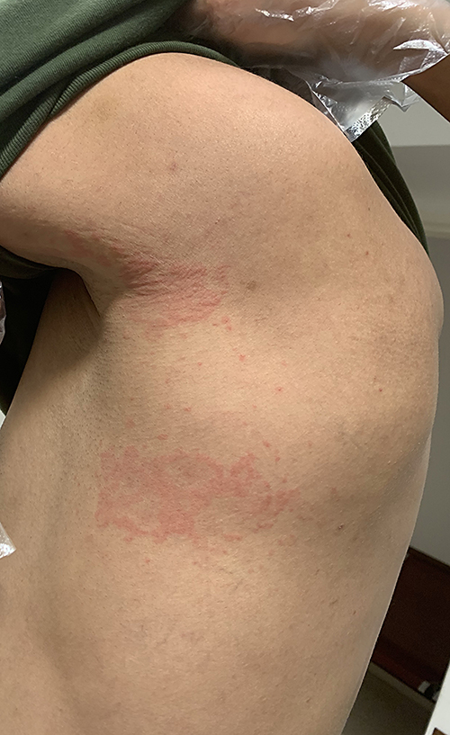 Fig. 2. Maculopapular rash on trunk.
