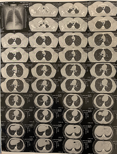 Fig. 3. Spiral lung CT scan.