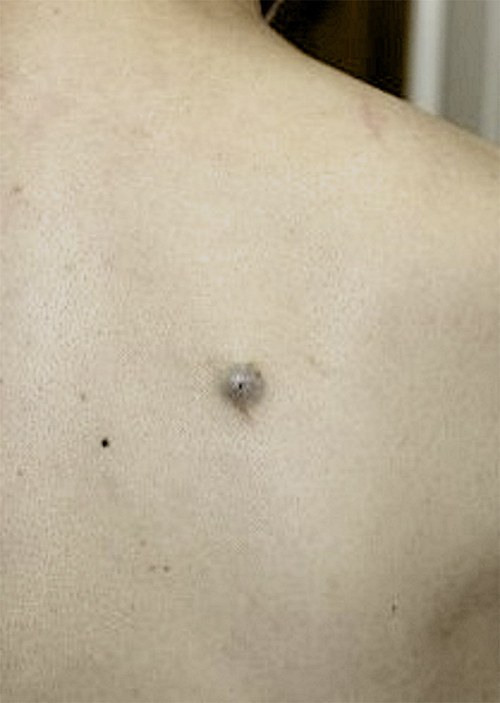 Fig. 1. Well-defined and dome-shaped lesions on the upper back.