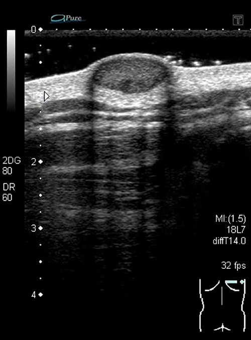 Fig. 2. Sonographic findings of lesions on the upper back.