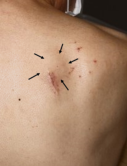 Fig. 3. Remaining lesion on the right upper back.