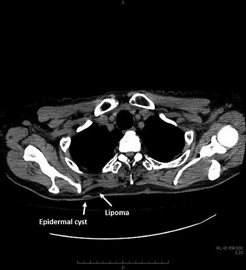 Fig. 4. Chest CT image before removal of epidermal cyst.