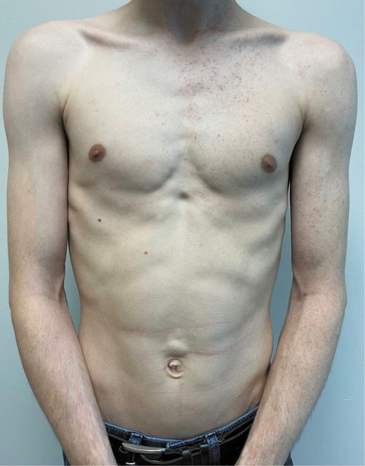 Fig. 1. UNT involving the left thorax and arm. UNT, unilateral nevoid telangiectasia.