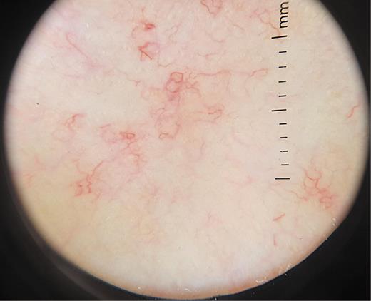 Fig. 2. Multiple patch of telangiectasia in dermatoscopy.