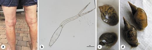 Fig. 1. Skin changes due to swimmer’s itch case from Esrum Sø. Photograph provided by the patient (a), Trichobilharzia cercariae released from the freshwater snail Lymnaea stagnalis sampled in lake Ringen Sø (b), Radix balthica sampled from lake Furesø (c), Lymnaea stagnalis collected from lake Ringen Sø, and (d), both were freshwater snails.