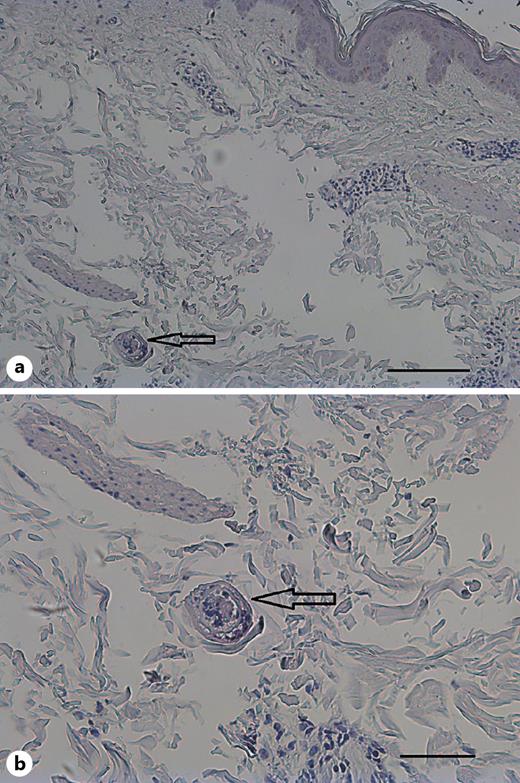 Fig. 3. Histological section of a papule (skin from patient’s arm). Hematoxylin/eosin stain ×5 with scale bar 100 μm (a), ×20 with scale bar50 μm (b).