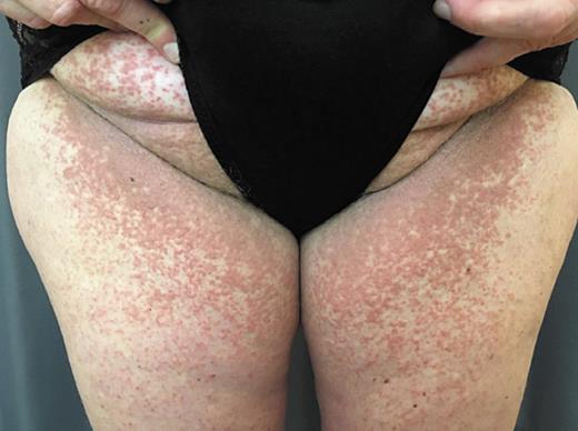 Fig. 1. Photo of the patient in the case presenting with flare of Darier’s disease.