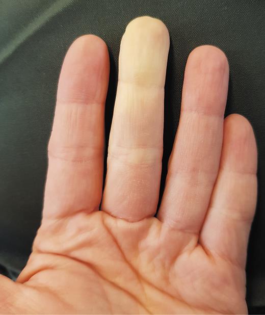 Fig. 1. Raynaud’s phenomenon. Well-demarcated, white-pale, cold areas affecting the middle finger of the left hand of a 31-year old, otherwise healthy, woman.