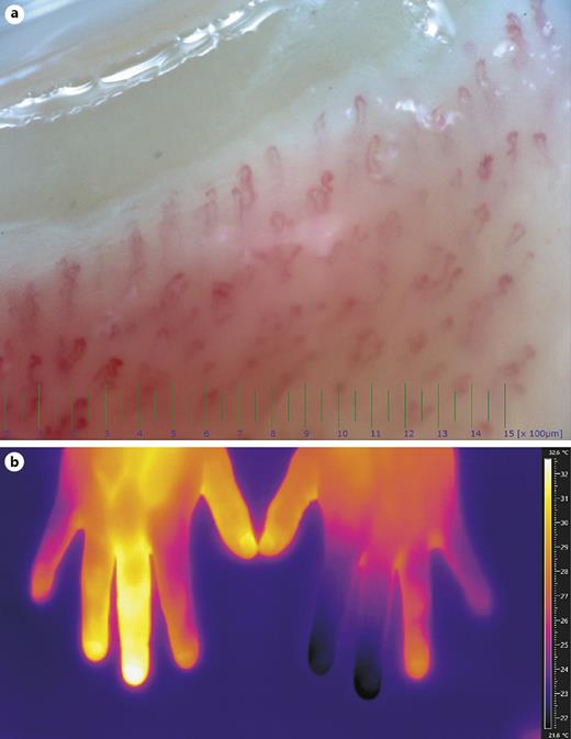 Fig. 2. A Nailfold capillaroscopy of the middle finger of the left hand showing normal morphology, density, and dimensions of the capillaries. B Thermogram of both hands, revealing temperature differences of up to 10.9°C between the individual fingers with 21.4°C and 21.2°C in the left index and middle finger, respectively, indicating reduced perfusion, and 32.1°C and 30°C in the right middle and ring finger, indicative of reactive hyperemia.