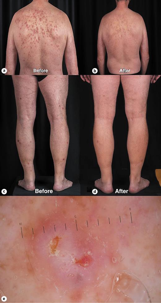 Fig. 1. Clinical pictures and dermoscopy. a, c Physical examination reveals erythematous eroded papules on the back and lower extremities of a patient with GD. b, d Progress 6 months after therapy with isotretinoin. e A central, stellar-like, yellowish keratotic plug with a white radiating rim along with linear and/or hairpin blood vessels. GD, Grover’s disease.