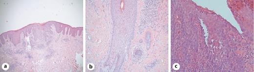 Fig. 2. Histopathology. a Section showing an overview of the skin (hematoxylin and eosin stain. ×25). Section revealing dyskeratotic keratinocytes (hematoxylin and eosin stain, magnification ×100) (b), close-up view showing acantholysis (hematoxylin and eosin stain, magnification ×200) (c).