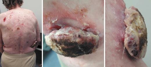 Fig. 1. Photograph of primary tumor localized on the right flank.