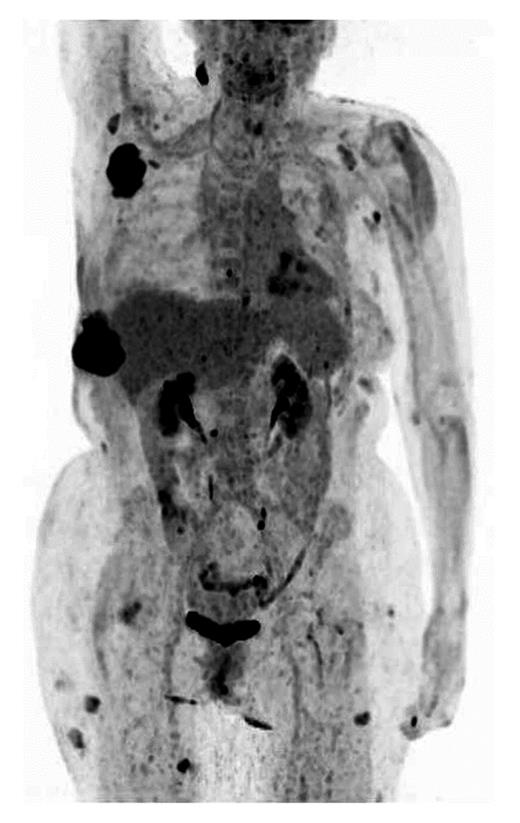 Fig. 2. PET/CT scan with multiple positive foci.