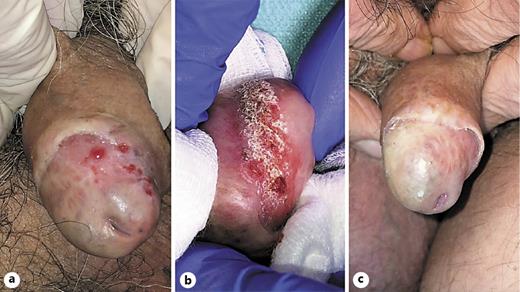 Fig. 1. a Multiple papulo-erythematous lesions on the glans. A biopsy of one lesion was performed, showing G2 keratinizing squamous cell carcinoma infiltrating the sub-epithelial connective tissue. b The ablation of the cutaneous lesions was performed with UltraPulse CO2 laser at 80 mJ and 5W using the handful which created a spot of 0.8 mm in size. Subsequently, methyl aminolevulinate (MAL)-photodynamic therapy (PDT) was performed. c After 6 months of follow-up, a resolution of cutaneous lesions was evident on clinical observation, without sign of local recurrences and with good esthetical impact.