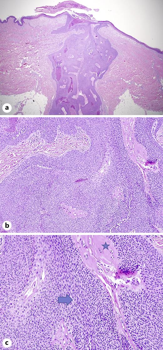 Poroid Hidradenoma Case Report and Comprehensive Review of the