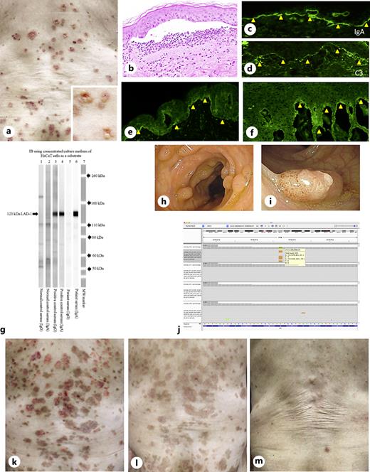 A Case of Lamina LucidaType Linear IgA Disease Complicated by Colon